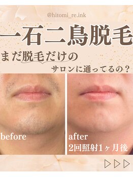 リンク(Re.ink)の写真/美容看護師監修◎結果重視の美肌光脱毛