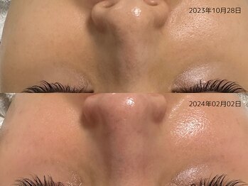 レイル(REIR)/メニュー:純粋レチノールピール