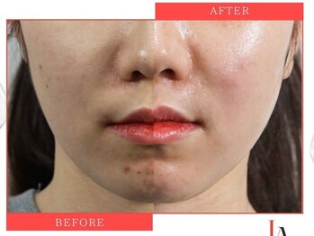 ビューティーリバース 東戸塚店/ララピール50分