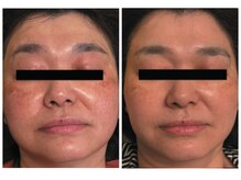 ラキ(LAKI)/ホワイトスノーピール