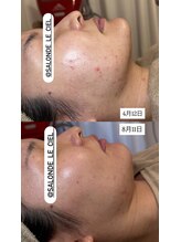 サロンドゥルシェル(salonde_le ciel)/繰り返すニキビもお任せ下さい！