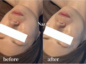 ナーズプラス リベルテ(Naz Plus/Liberte)/乳酸ピール