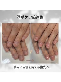 深爪矯正/自爪育成/秋葉原