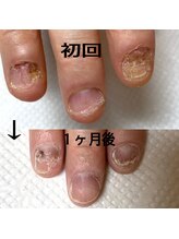 ミガクネイル(Migaku nail)/深爪改善コース