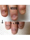 深爪改善コース