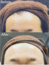 ブランシェ 富山店 × 椿/シワ・たるみケア　お客様