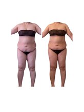 ヴィアス(VIAS)/セルゼロ6回の効果！