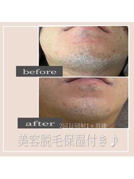 リリールア(Rere-Rua)/メンズ脱毛♪