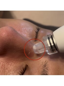 にっこりビューティー/★ハイドラフェイシャル毛穴洗浄