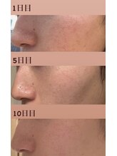 ミピマム 恵比寿店(Mipimam)/毛穴洗浄 &nbsp;変化写真