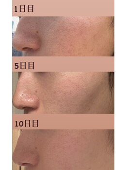 ミピマム 恵比寿店(Mipimam)/毛穴洗浄 &nbsp;変化写真