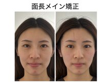 エレヴィザ トウキョウ 恵比寿院(ELVISA TOKYO)/面長メイン改善 / 初回施術