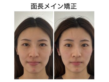 エレヴィザ トウキョウ 恵比寿院(ELVISA TOKYO)/面長メイン改善 / 初回施術