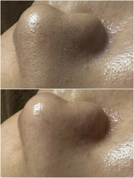 エステルーム クリスタル/3種の美容液を使用した毛穴洗浄