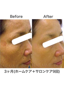 ブレリアントサロン 池袋店(brillant salon)/【50代】年齢肌トータル改善