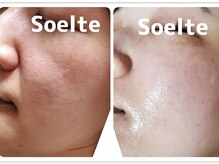 ソエルテ(Soelte)/肌を根本改善！韓国幹細胞エステ