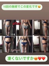 アンリール 旭川店(Anrire)/BODY施術のお客様です！