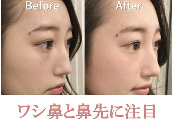 隆鼻矯正専門店 ラプリ(Raplit)/隆鼻＋輪郭矯正40分10回