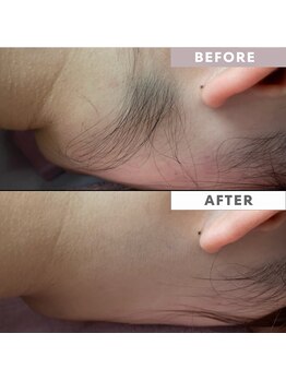 ランプシー(Lampsi)/うなじ脱毛