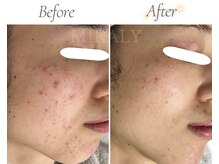 ミラリー(MIRALY)/全顔ニキビケア 6ヶ月(20代前半)