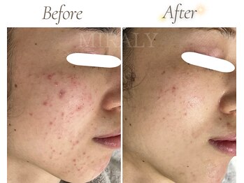 ミラリー(MIRALY)/全顔ニキビケア 6ヶ月(20代前半)