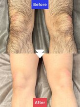 フィズ 新越谷店(FIS)/MENS 脚脱毛