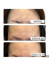 リセル(Recell)/本気のしみ改善