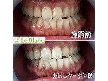 ルブラン 奈良店(Le Blanc)/自然な白い歯