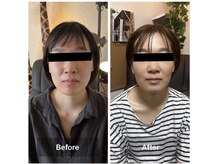 リノリー(rinory)/小顔矯正