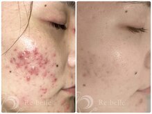 ビースキン 藤沢店(BeSkin)/リベルハーブピーリング(DT有)