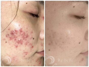 ビースキン 藤沢店(BeSkin)/リベルハーブピーリング(DT有)