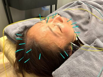 ラナスサッポロ(RUNUS SAPPORO)/【美容鍼】