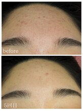 ラミーユ(La Miu)/ハーブピーリング5回目の変化