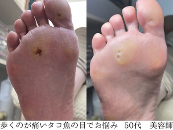 足裏角質・タコ魚の目ケア