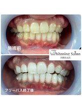 ホワイトニングサロン 京都烏丸店/ホワイトニング施術例
