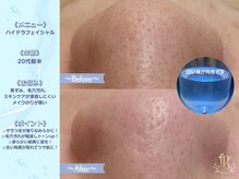 リリーベル 新宿歌舞伎町(Lily Belle)/ハイドラフェイシャル