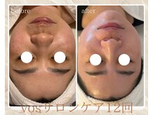 サロン ド ボーテ ラーンジュ 岐阜店(salon de beaut'e L'ange)/本気の肌改善毛穴、ニキビ、小顔