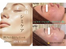 サロンドショコラ(salon de chocolat)の雰囲気（IPLフォト美白/くすみ・シミケアにはグルタチオン導入もオススメ）