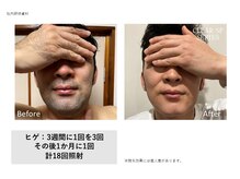 トータルクリア(TOTAL CLEAR)/髭脱毛