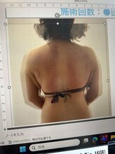 ミッシュ(Mish)/背中施術の結果