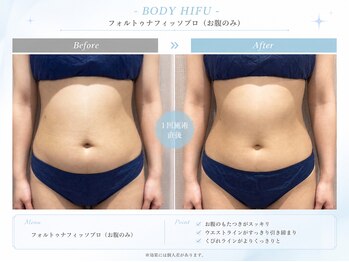 スカイトータルビューティー(Sky Total Beauty)の写真/蓄熱式超音波で心地よくサイズダウン★全身・部位別集中ケアで理想のすっきりボディラインへ導く！