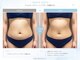 スカイトータルビューティー(Sky Total Beauty)の写真/蓄熱式超音波で心地よくサイズダウン★全身・部位別集中ケアで理想のすっきりボディラインへ導く！