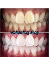 ホワイトニングショップ 和歌山店/圧倒的美白セルフホワイトニング