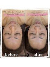 エステティックサロンフランジパニ(frangipani)/たるみ改善◎1回の効果！！