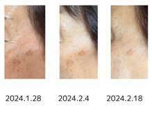 リセル(Recell)/ヒト幹細胞培養上清液導入