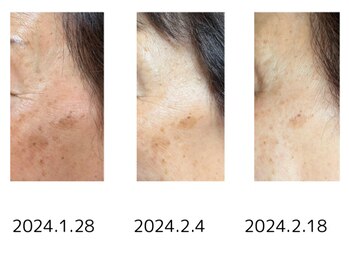 リセル(Recell)/ヒト幹細胞培養上清液導入