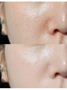 オーシャンブルーム 目黒(OceanBloom)/毛穴乾燥