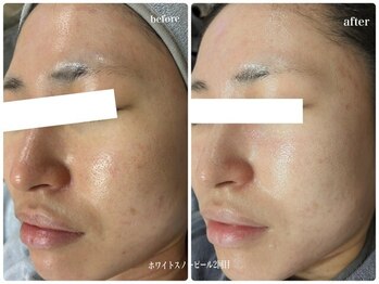 ブロッサム(Blossom)/ホワイトスノーピール肌質改善