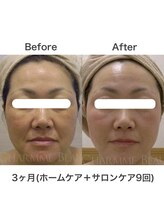 ブレリアントサロン 池袋店(brillant salon)/【40代】年齢肌トータル改善