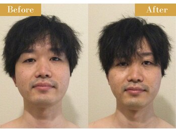 モモスパ(MOMOspa.)/頭蓋骨小顔矯正ビフォアフター